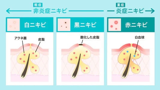 【医師監修】ニキビを即効で治す方法は残念ながらない｜目立ちにくくする方法を紹介