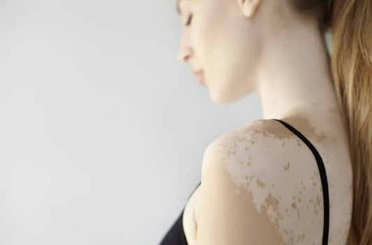 色素沈着は自分で治すことができる？原因と効果的なケアを詳しく解説