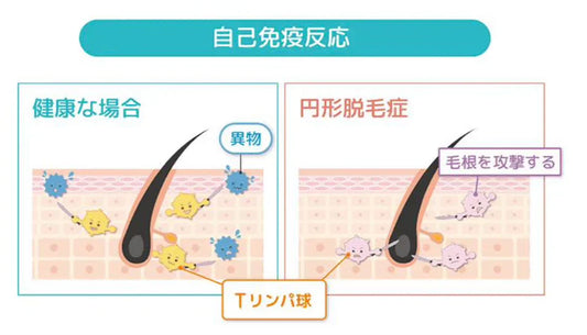 【医師監修】女性の円形脱毛症の原因・年代別の特徴と対処法を解説