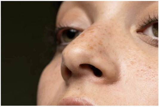 鼻のシミの原因と対策｜レーザー治療やコンシーラーでの隠し方も解説
