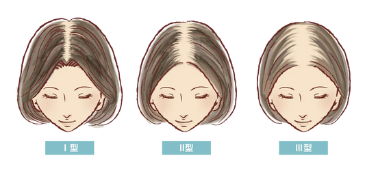 女性の「分け目はげ」は治せる？原因や目立たなくする方法を解説！