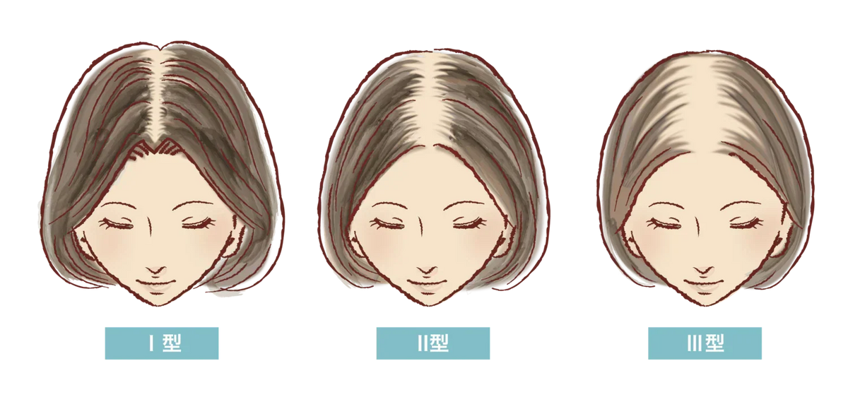 女性の「分け目はげ」は治せる？原因や目立たなくする方法を解説！