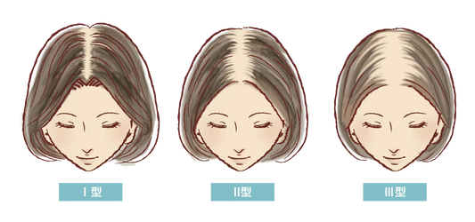 女性の「分け目はげ」は治せる？原因や目立たなくする方法を解説！