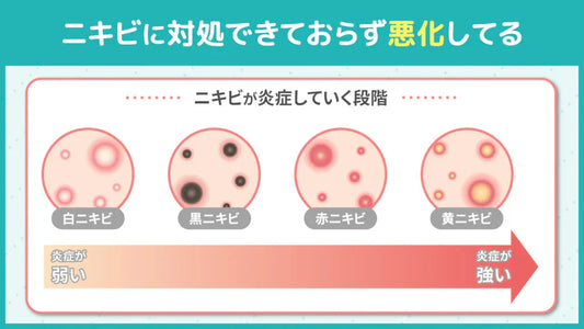 ニキビが何をしても治らないのはなぜ？全然治らない原因と対処法を解説