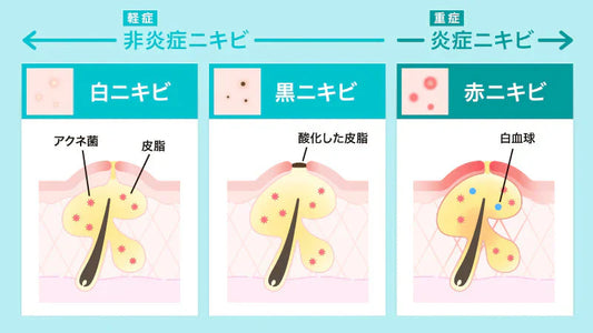 皮膚科に行ってもニキビが治らないなら試したい方法とチェック方法を解説
